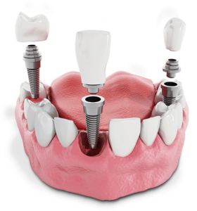 Multiple Dental Implant Model