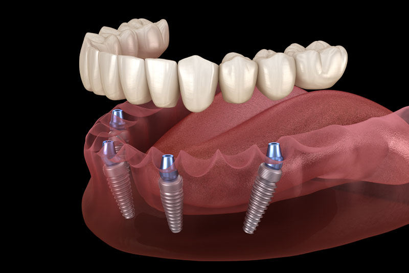 All On 4 Dental Implants Prothesis Above Gum Line