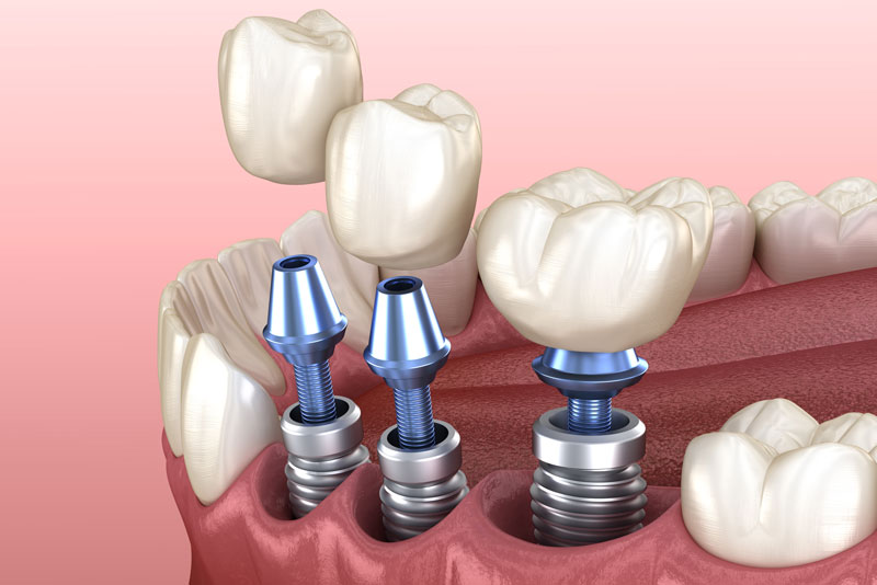 Multiple Single Dental Implant With Crowns