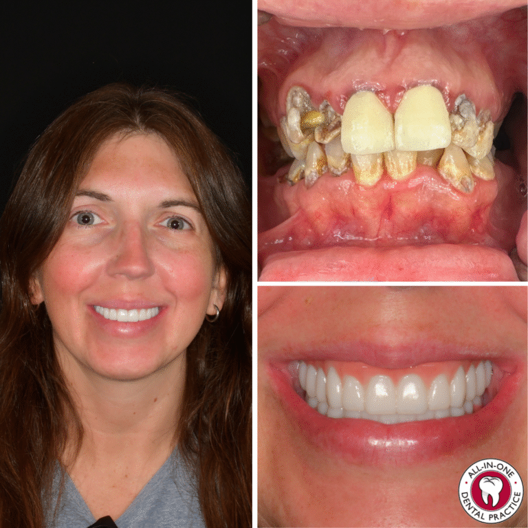 A woman with medium-dark skin and a nose ring smiles, showing her teeth. Close-ups to the right highlight her white, even teeth. The bottom right corner shows an “All-In-One Dental Practice” logo.