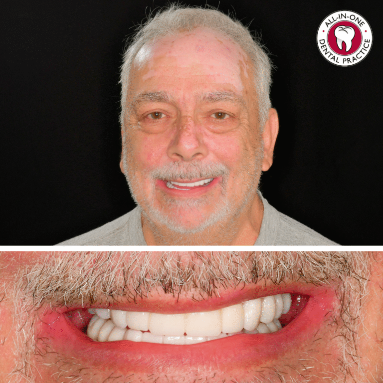 A smiling older man with gray hair and beard is shown against a black background. Below is a close-up of his mouth, displaying even, white teeth. A logo at the top right reads “All-In-One Dental Practice.”.
