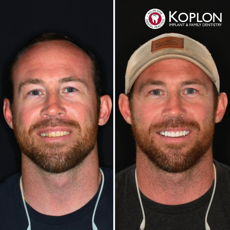 Side-by-side photos of a bearded man before and after dental work. In the after image, he wears a tan cap and smiles widely, revealing straight, bright teeth. Koplon Implant Family Dentistry logo is in the top right.