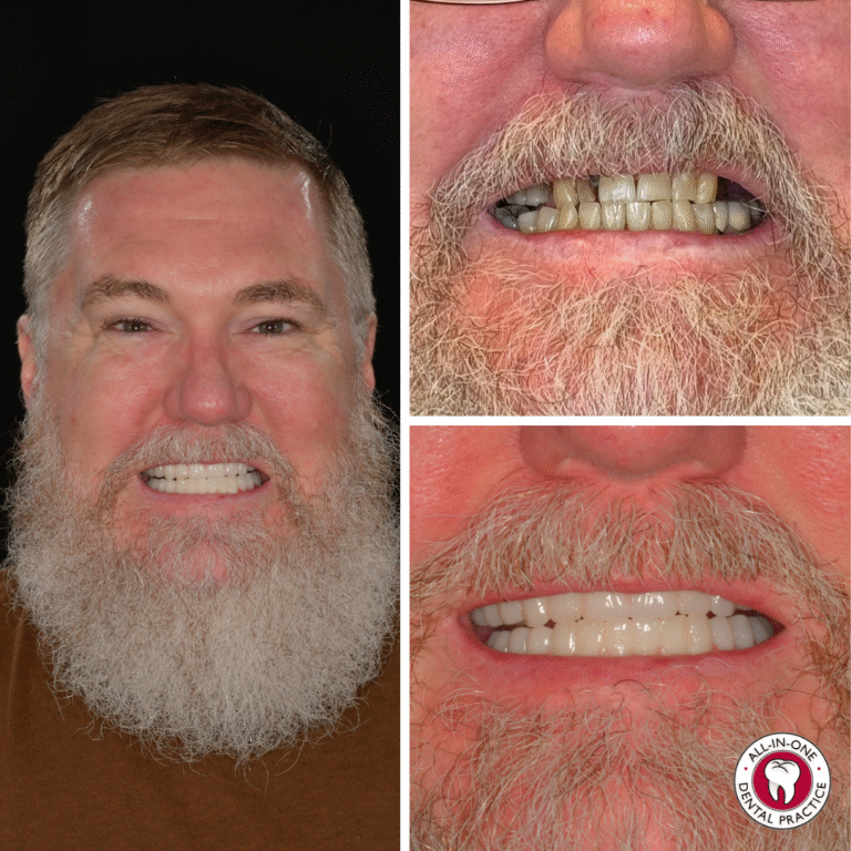 A bearded man smiles in a side-by-side comparison: the left shows him smiling widely, while the right displays close-ups of stained, uneven teeth above and bright, straight teeth after dental work below. Dental clinic logo in corner.