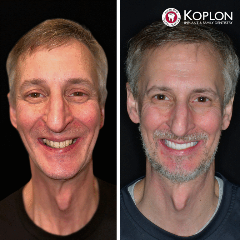 Side-by-side photos of a smiling middle-aged man before and after dental treatment. The left shows uneven, missing teeth; the right shows straight, white teeth. “Koplon Implant Family Dentistry” logo is in the top right corner.