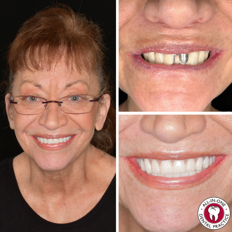 A woman with glasses smiles. Top right: her mouth shows damaged teeth and a metal dental implant. Bottom right: her mouth shows a full set of straight, white teeth. All-In-One Dental Practice logo in the corner.