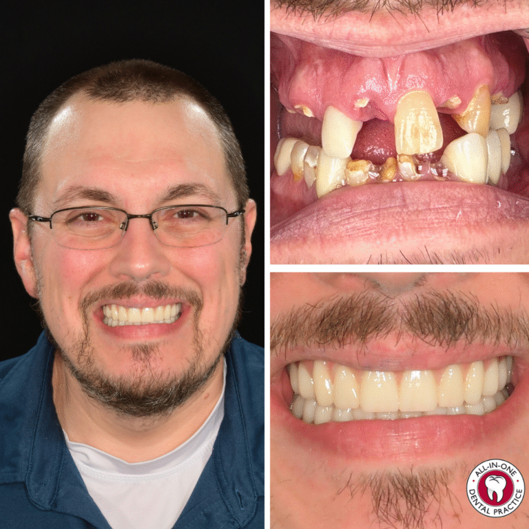 A man with glasses smiles; an inset above highlights his discolored, misaligned, and missing upper teeth, while the lower inset reveals his new, straight, white dental implants. The All-In-One Dental logo is in the corner.