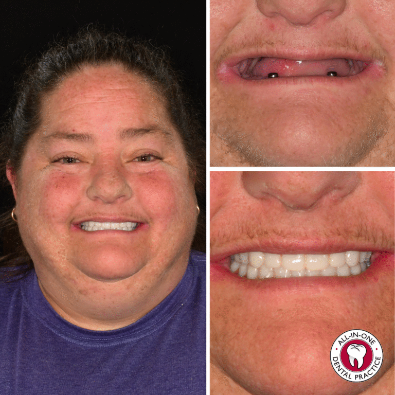 A woman smiles in a left-side portrait. Right: close-ups of her toothless upper gums and new dental implants. Dentist logo shown.