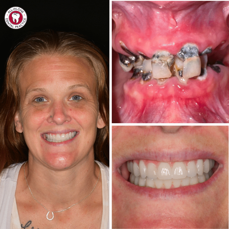 A woman smiles in a portrait on the left. Top right: close-up of decayed, broken upper teeth. Bottom right: close-up of her mouth showing straight, white, healthy teeth after dental treatment.