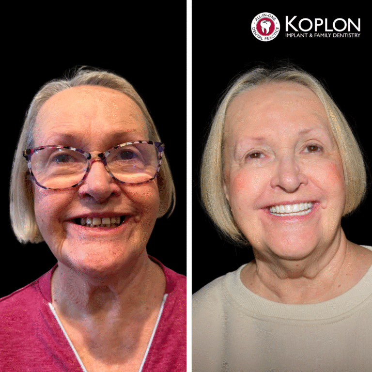 A split image shows an older woman before and after dental work. On the left, she wears glasses and smiles with visible teeth gaps; on the right, she smiles with straight, even teeth without glasses. "Koplon" dental logo is above right.