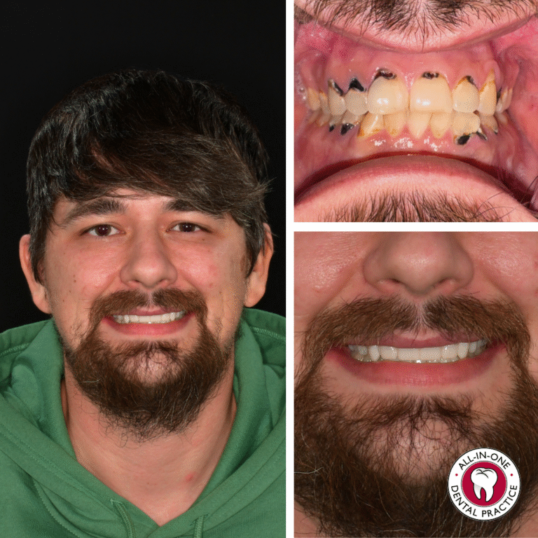 A smiling man with dark hair and a beard. Close-ups show his teeth before with severe decay, then after treatment, clean and white. Dentist logo at bottom right corner.