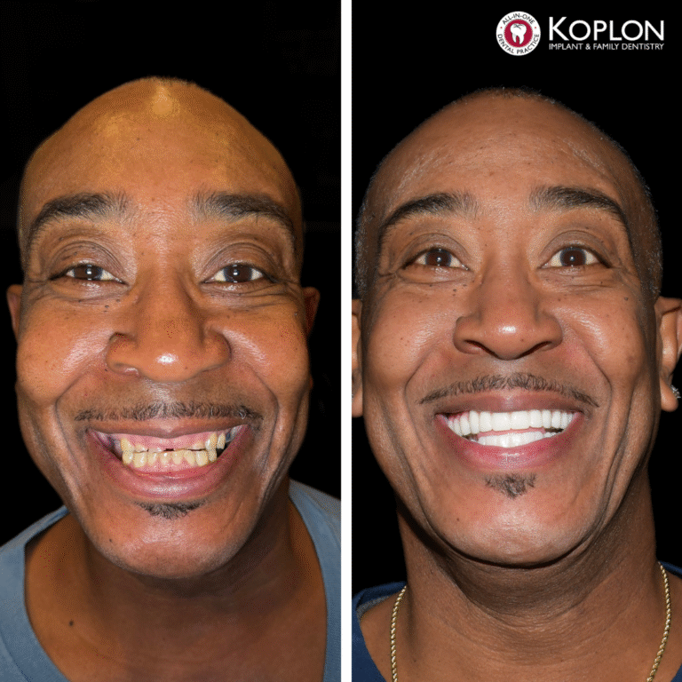 Side-by-side photos of a smiling man before and after dental work; the left shows uneven, missing teeth, while the right displays straight, bright white teeth. "Koplon Implant Family Dentistry" logo in the top right corner.