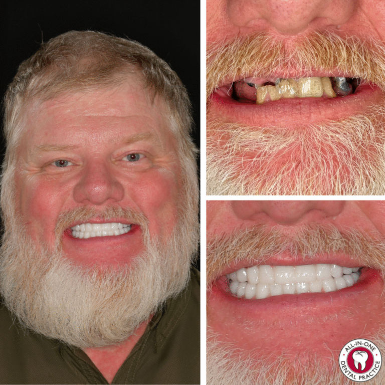 A bearded man smiles; left panel shows bright, even teeth. Top right shows his natural, damaged teeth; bottom right displays new, white dental implants. All-In-One Dental Practice logo appears in the bottom right corner.