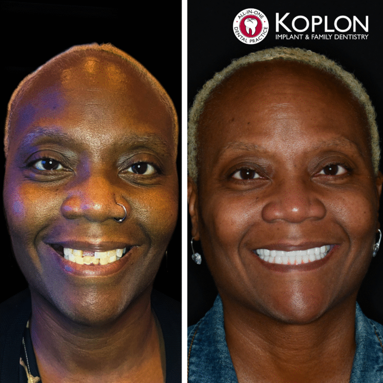 Side-by-side photos of a smiling person before and after dental work. Left shows missing and discolored teeth. Right features even, bright white teeth. “Koplon Implant Family Dentistry” logo is in the top right corner.