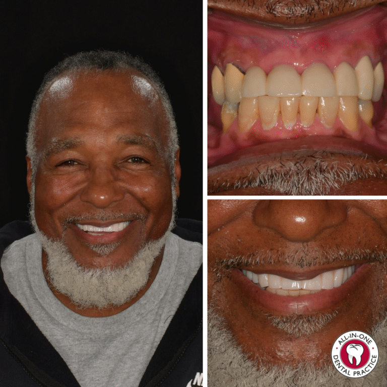 A smiling older man with a gray beard; close-ups show his teeth before and after dental work. The practice logo is in the corner.