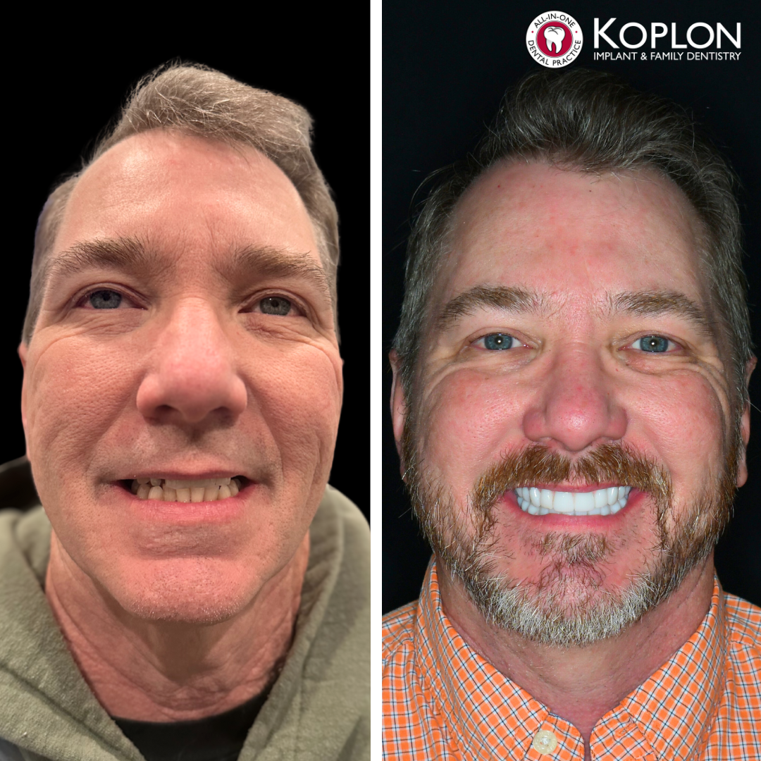 A side-by-side comparison photo shows a man before and after dental treatment. On the left, his teeth are uneven and discolored. On the right, his teeth are straight and very white; he is smiling widely. The Koplon Implant Family Dentistry logo appears in the upper right.