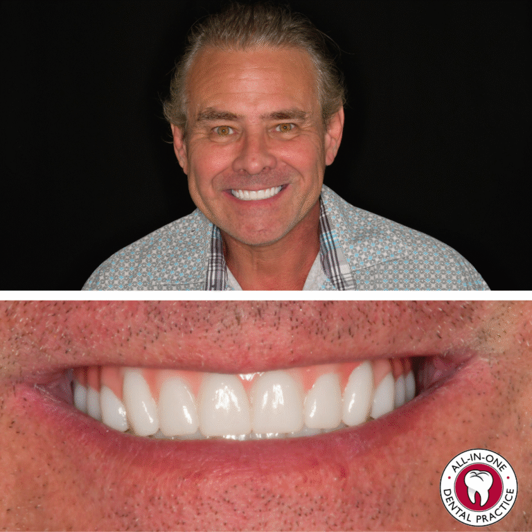 A smiling middle-aged man in a patterned shirt is shown, with a close-up beneath that highlights his bright, white teeth. The All-In-One Dental Practice logo is visible in the bottom right corner.