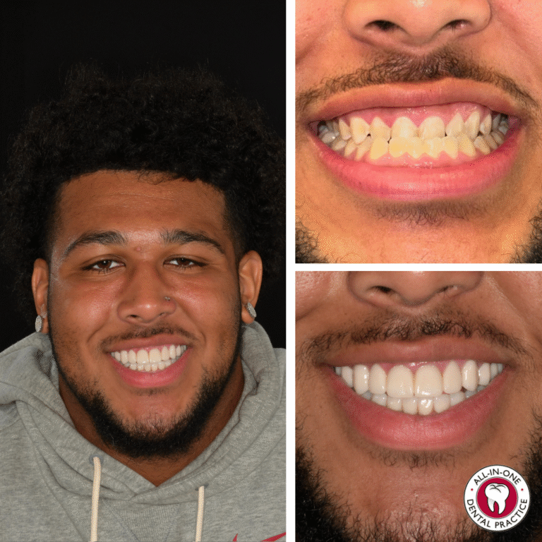 A smiling man shows his teeth; close-ups compare his uneven, yellowish teeth before treatment top right and straight, bright white teeth after dental work bottom right. All-In-One Dental Practice logo is at the bottom.