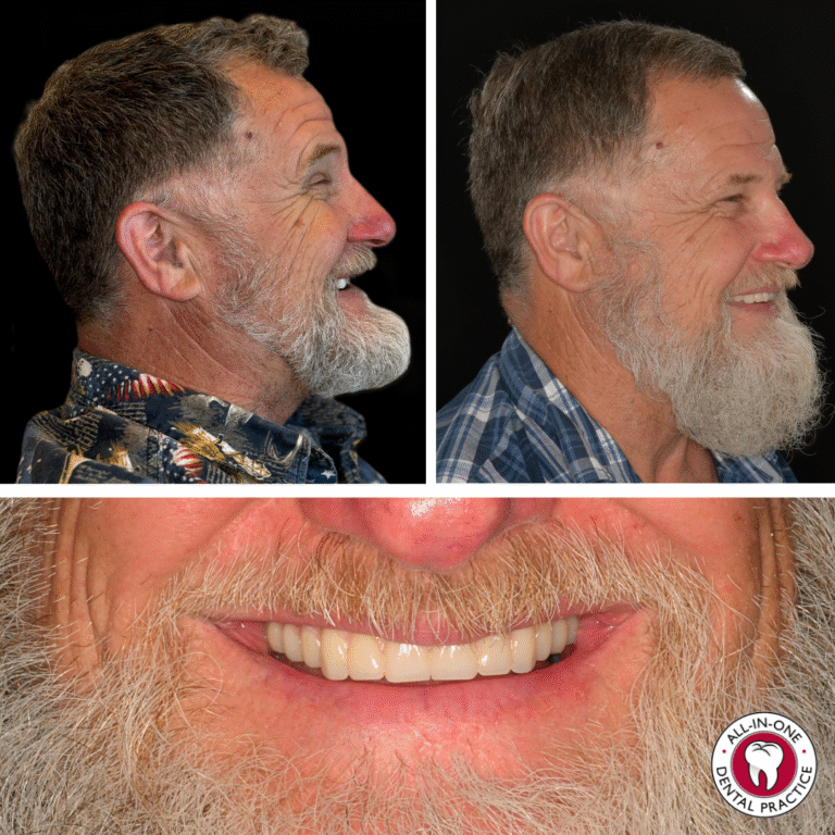 A smiling older man with gray hair and beard is shown in profile before and after dental work, wearing a blue shirt. The close-up emphasizes his new, bright teeth. A dental practice logo is at the bottom right.