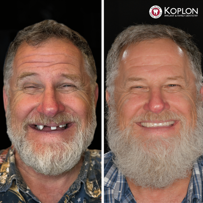 A bearded man appears in a side-by-side before and after comparison. On the left, he is missing front teeth while smiling. On the right, he has a full set of teeth and smiles widely. Koplon Dentistry logo is at the top right.