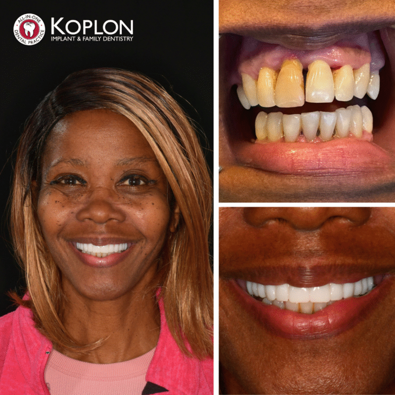 A smiling woman is on the left; right side shows her teeth before (discolored, uneven) and after (straight, white). Koplon Dentistry logo top left.