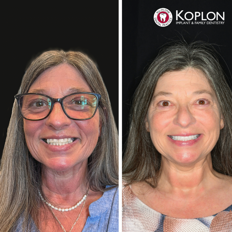 Side-by-side photos of a smiling woman before and after dental work. Left: she wears glasses, her teeth slightly uneven. Right: without glasses, her teeth appear straighter and whiter. Koplon Dentistry logo top right.