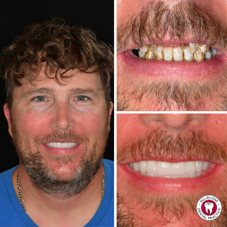 A man with wavy brown hair and a trimmed beard smiles. To the right: his stained, uneven teeth above his new, bright, even teeth below. Bottom right corner shows the “All-In-One Dental Practice” logo.