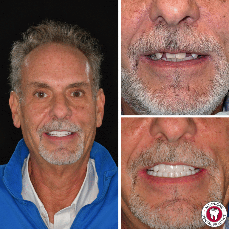 A man with gray hair and a trimmed beard is shown smiling. The left image displays his full face; the right shows close-ups of his mouth before and after dental work, showing missing then restored teeth.