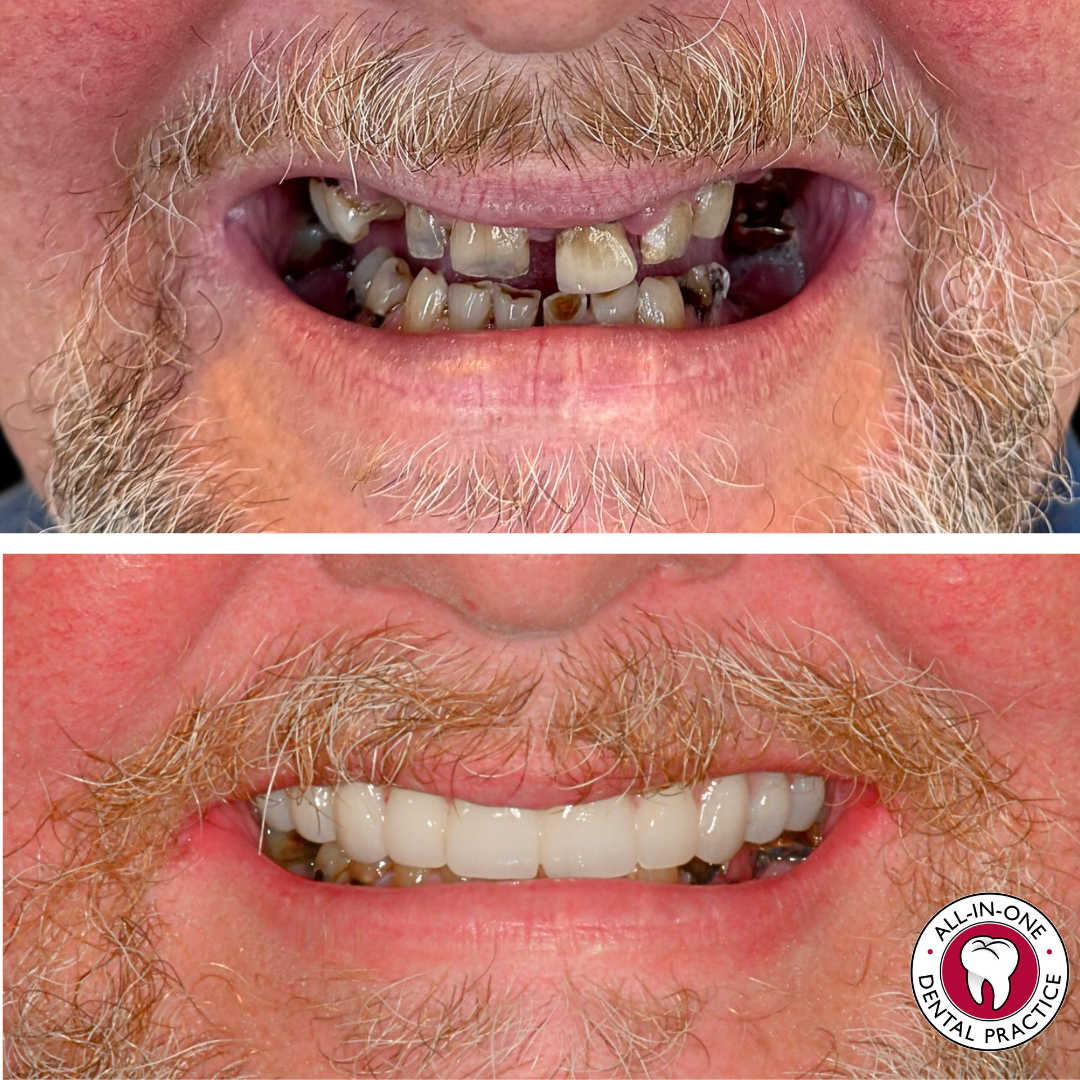 Two close-up photos of a man’s mouth: the top shows decayed, broken, and missing teeth; the bottom shows a healthy, even set of white teeth. Both images feature facial hair and the dental practice logo.