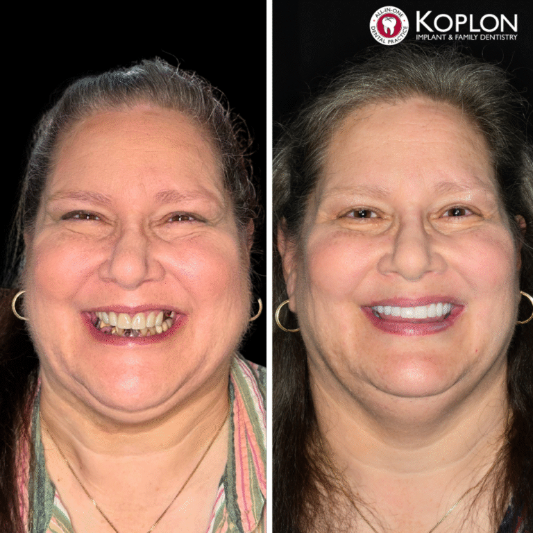 Side-by-side photos of a smiling woman before and after dental treatment. Left: her teeth are uneven and discolored. Right: her teeth are straight, white, and even. Koplon Implant Family Dentistry logo in the top-right corner.
