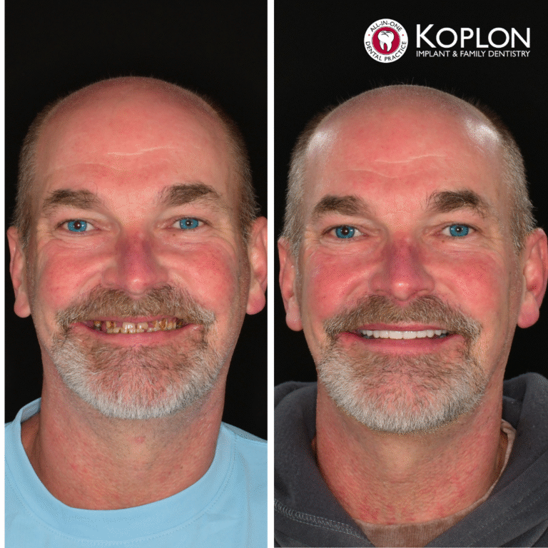 Side-by-side photos of a smiling middle-aged man before and after dental work. The left shows discolored, uneven teeth; the right shows white, even teeth. The Koplon Implant Family Dentistry logo is at the top right.