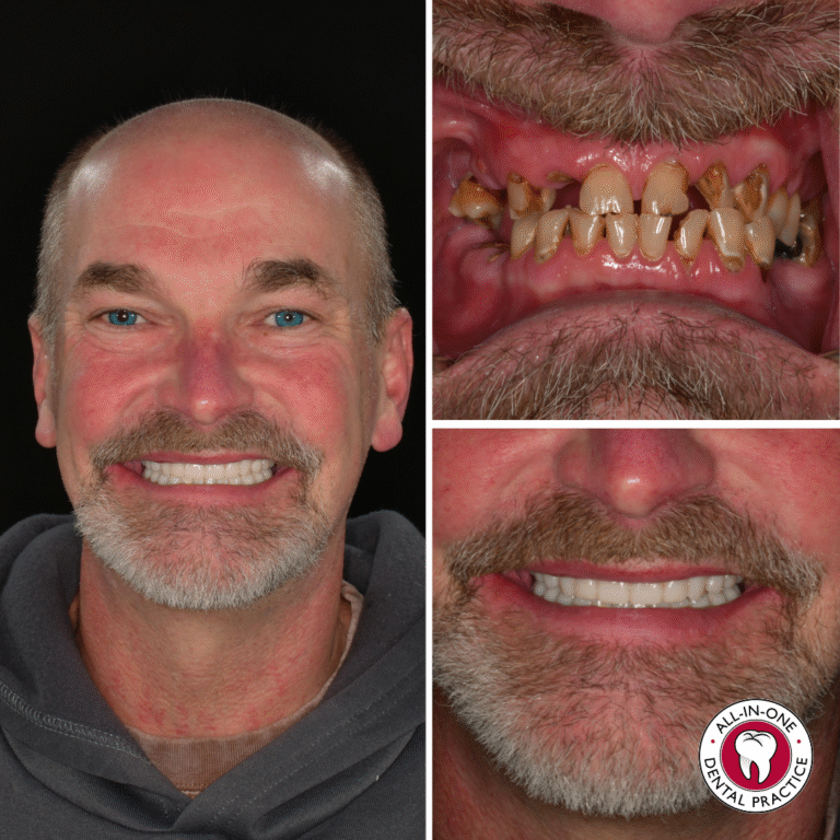 A man smiling with new white teeth. Left: full face, wide smile. Top right: close-up of damaged teeth. Bottom right: close-up of even teeth. All-In-One Dental Practice logo is visible.