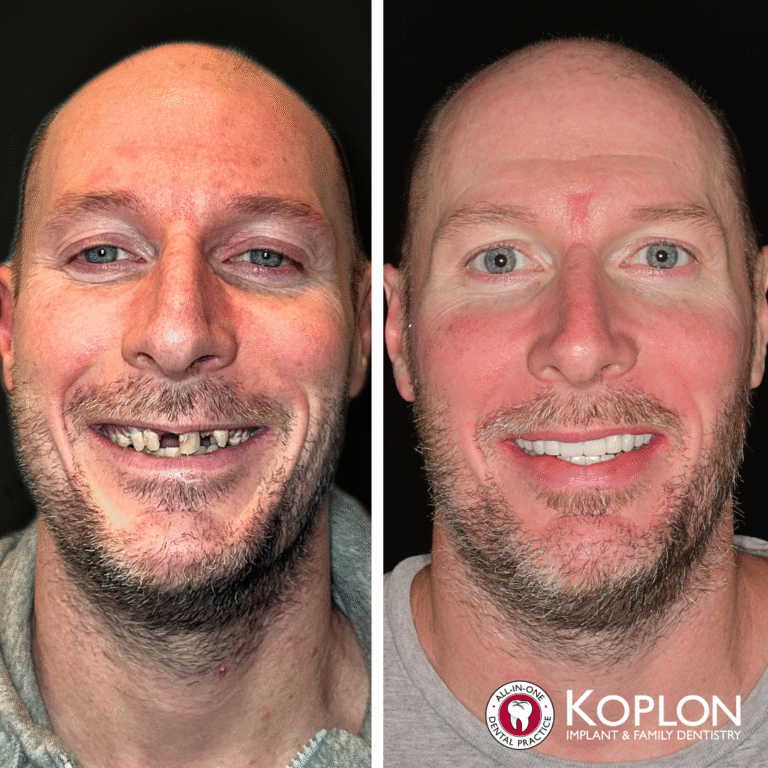 Side-by-side photos of a bald man with a beard: left shows missing and uneven teeth, right shows a full set of even, white teeth. The logo for Koplon Implant Family Dentistry appears in the bottom right corner.