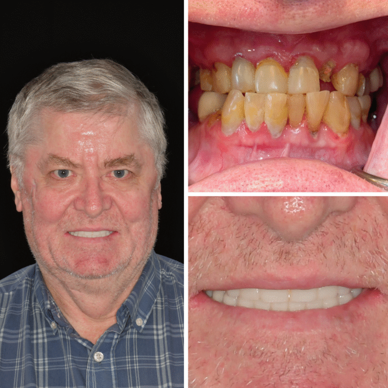 A composite image shows an older man smiling, a close-up of stained and misaligned teeth before dental work, plus a close-up of his mouth after treatment with clean, straight, white teeth.
