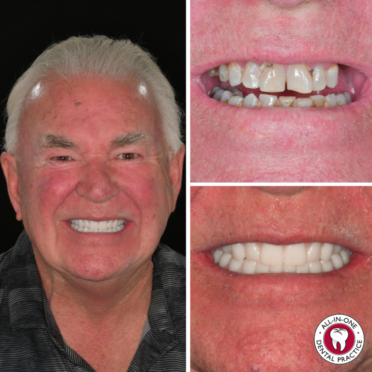 Older man smiling, shown before and after dental work. Top right: close-up of discolored, uneven teeth. Bottom right: close-up of even, white teeth. All-In-One Dental Practice logo in lower right corner.