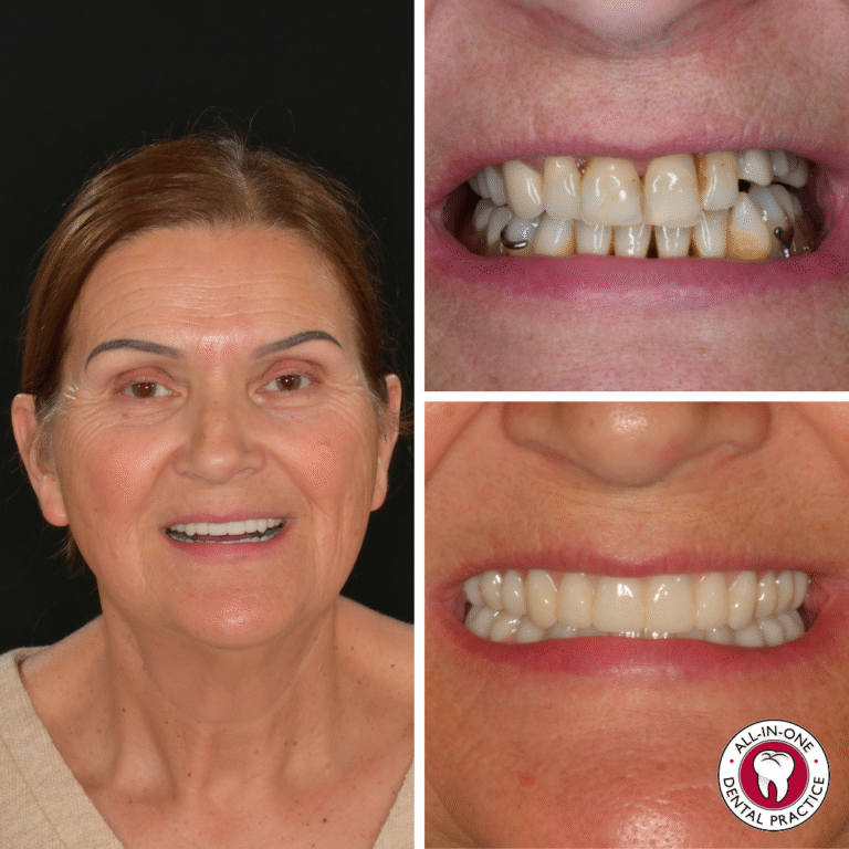 Split image showing a woman smiling, her teeth before dental treatment (discolored and misaligned), and after treatment with straight, white teeth. The All-in-One Dental Practice logo is in the bottom right corner.