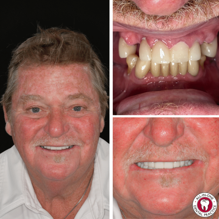 A smiling older man is shown in a split image: the left side shows his portrait with natural teeth, top right displays uneven and worn teeth, and bottom right features a close-up of his new even white dental implants.