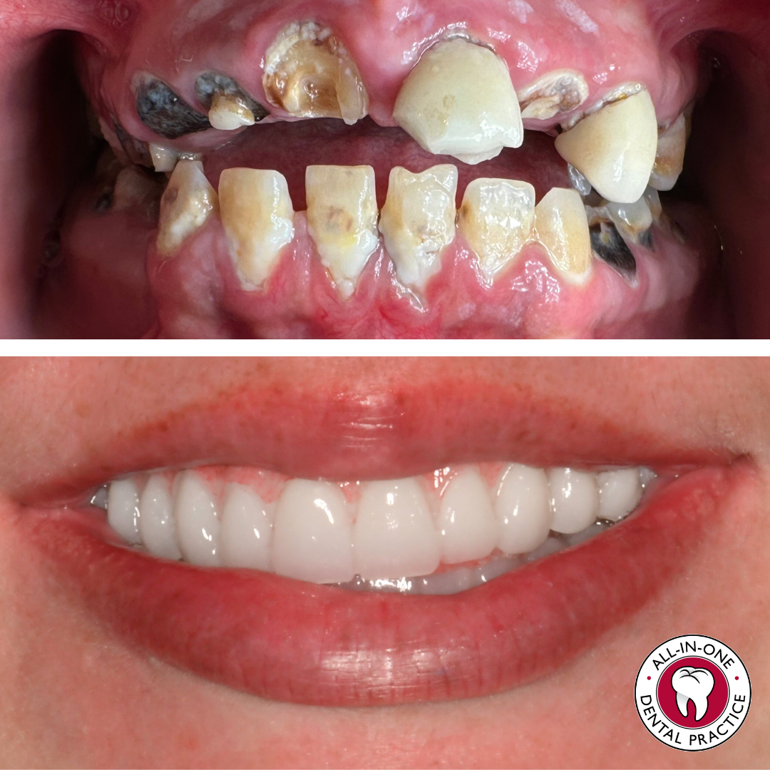 A before-and-after image: the top shows decayed, broken, discolored teeth; the bottom displays a close-up of healthy, white, even teeth with a smile. All-In-One Dental Practice logo appears in the bottom right corner.