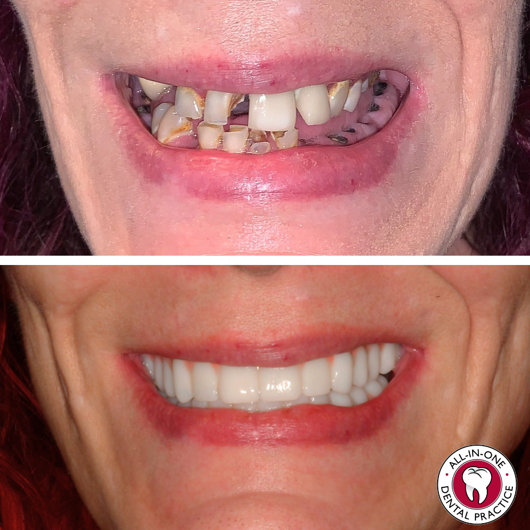 Close-up before-and-after photos of a person's smile. Top: crooked, discolored teeth. Bottom: straight, white teeth. Dental clinic logo.