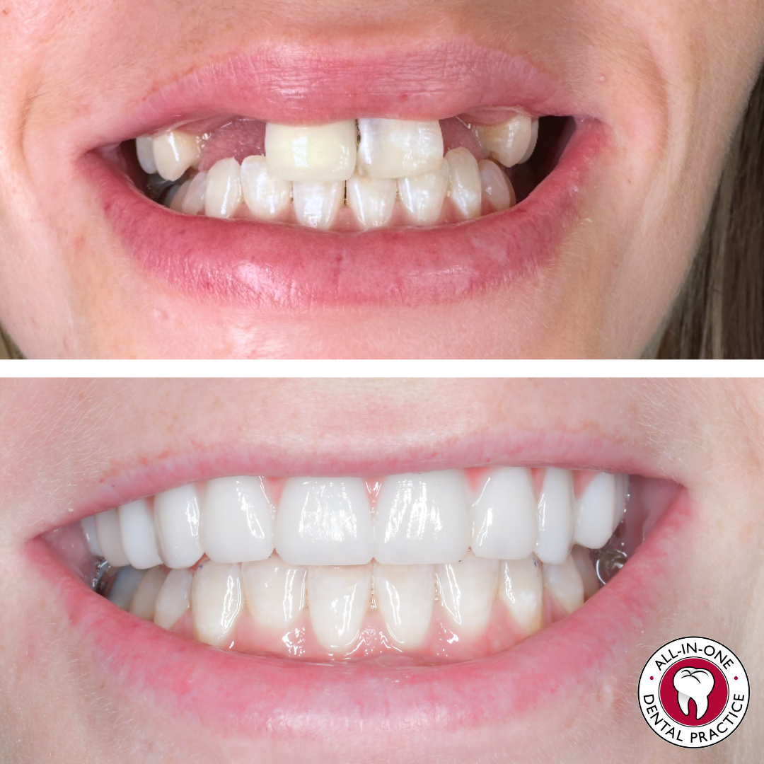 Before-and-after image of dental work: top has uneven, discolored, missing teeth; bottom has straight, white, healthy teeth. Clinic logo at lower right.